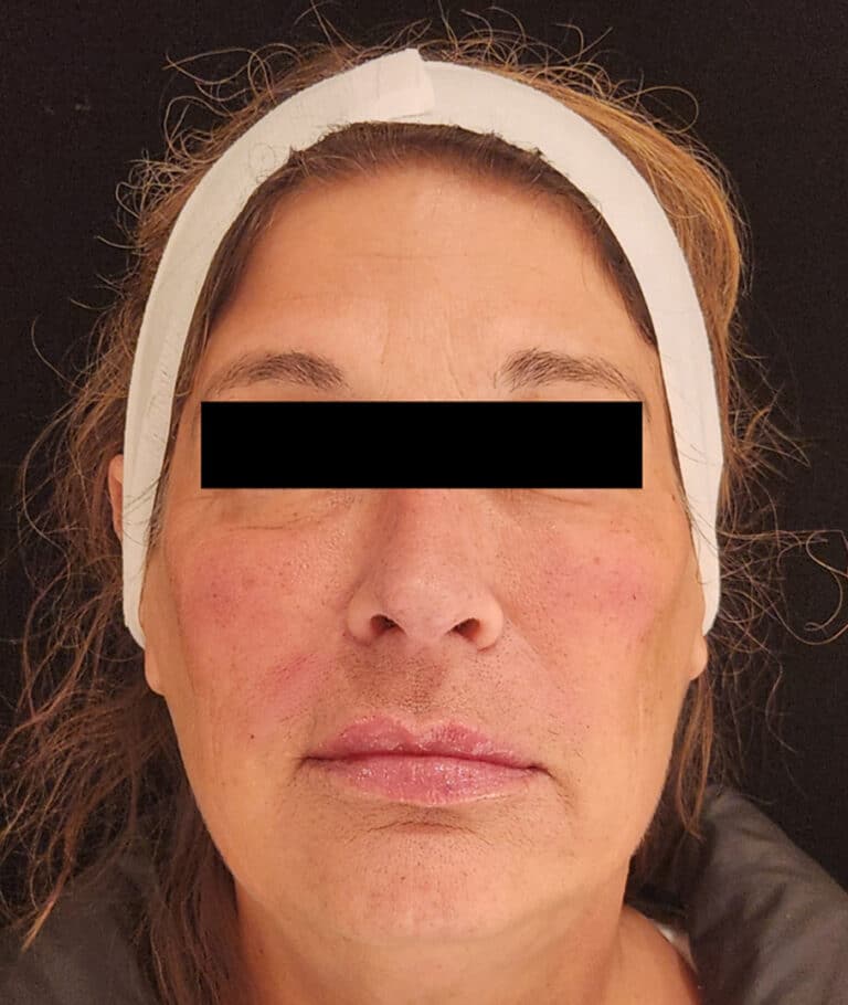 EZGel After