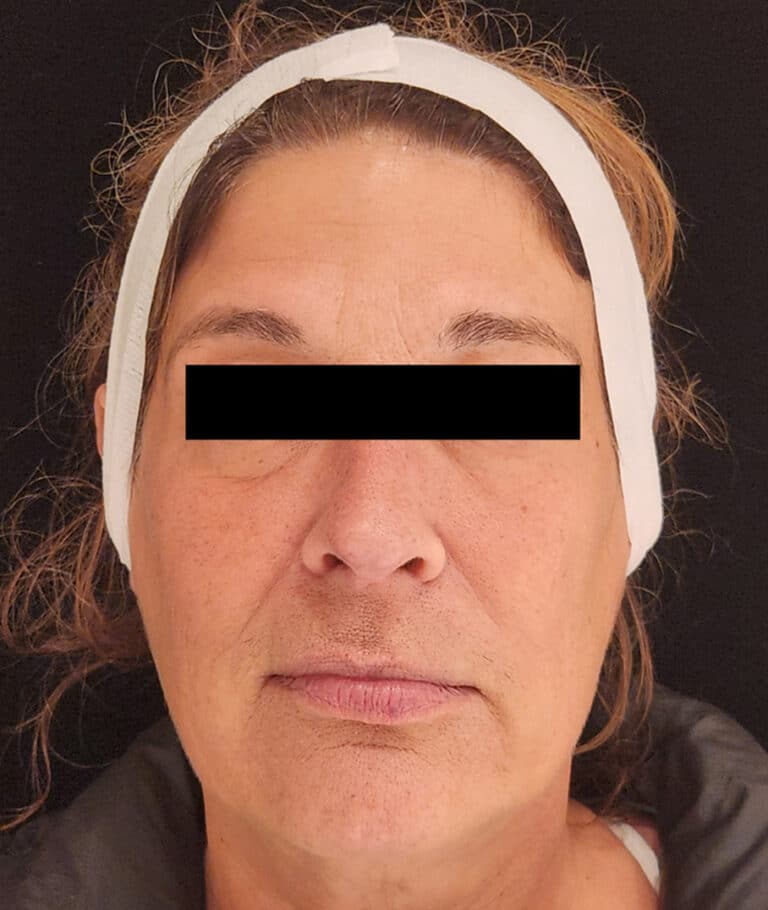 EZGel Before