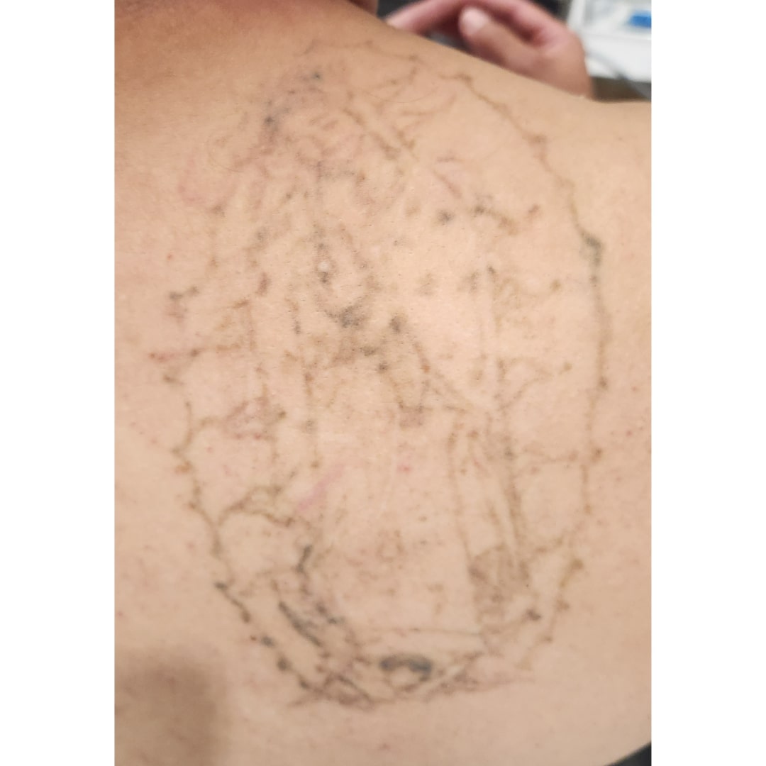 Laser tattoo removal after 1 session Tracie Conner