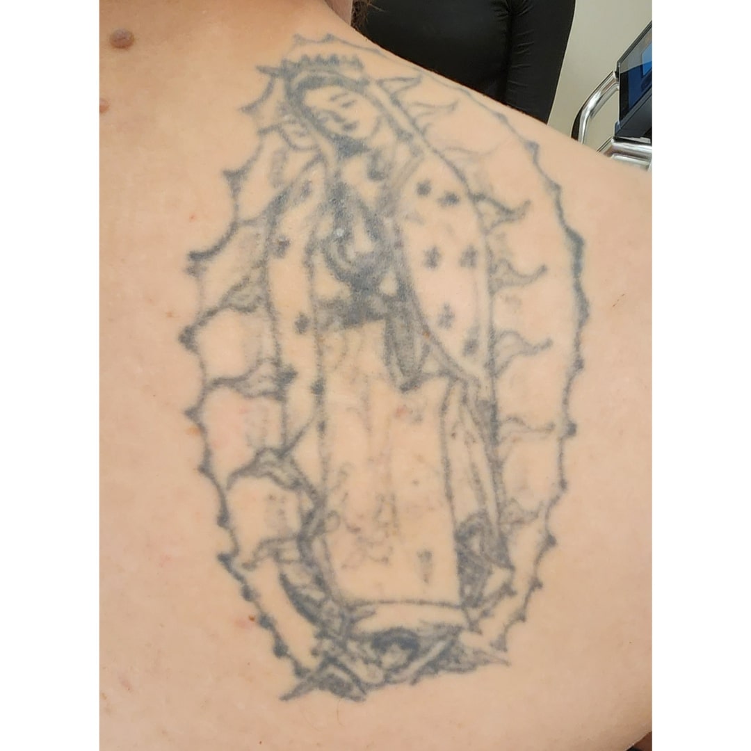 Laser tattoo removal before 2 Tracie Conner