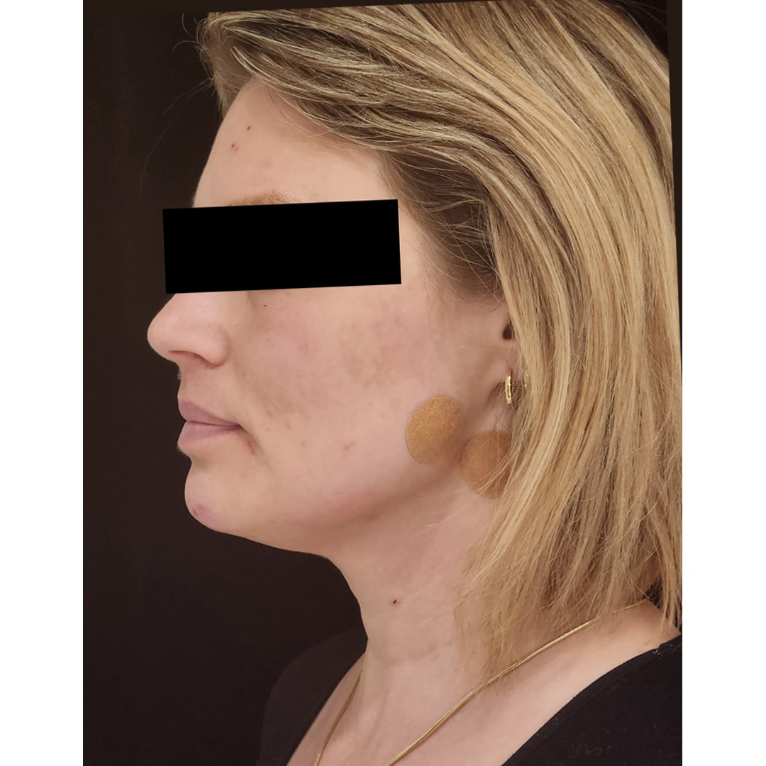 PDO thread submental and jaw lift after1 Tracie Conner