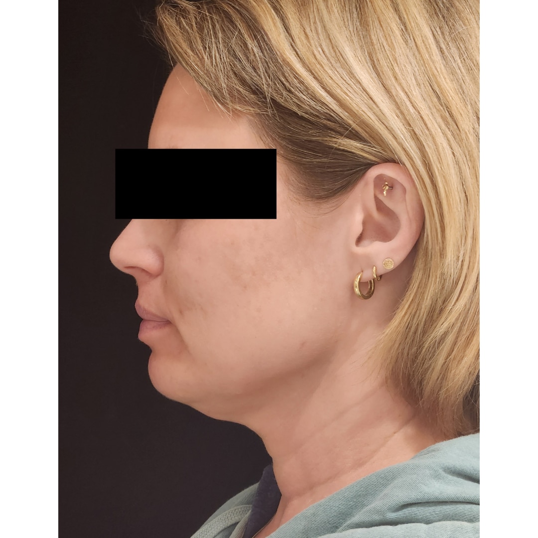 PDO thread submental and jaw lift before1 Tracie Conner