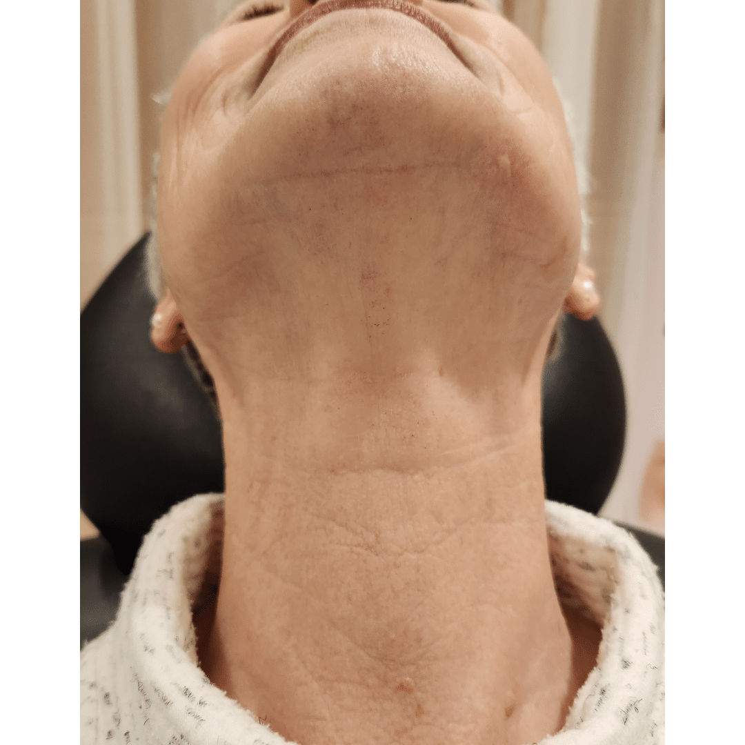 Vascular birthmark removal after 2 sessions Tracie Conner