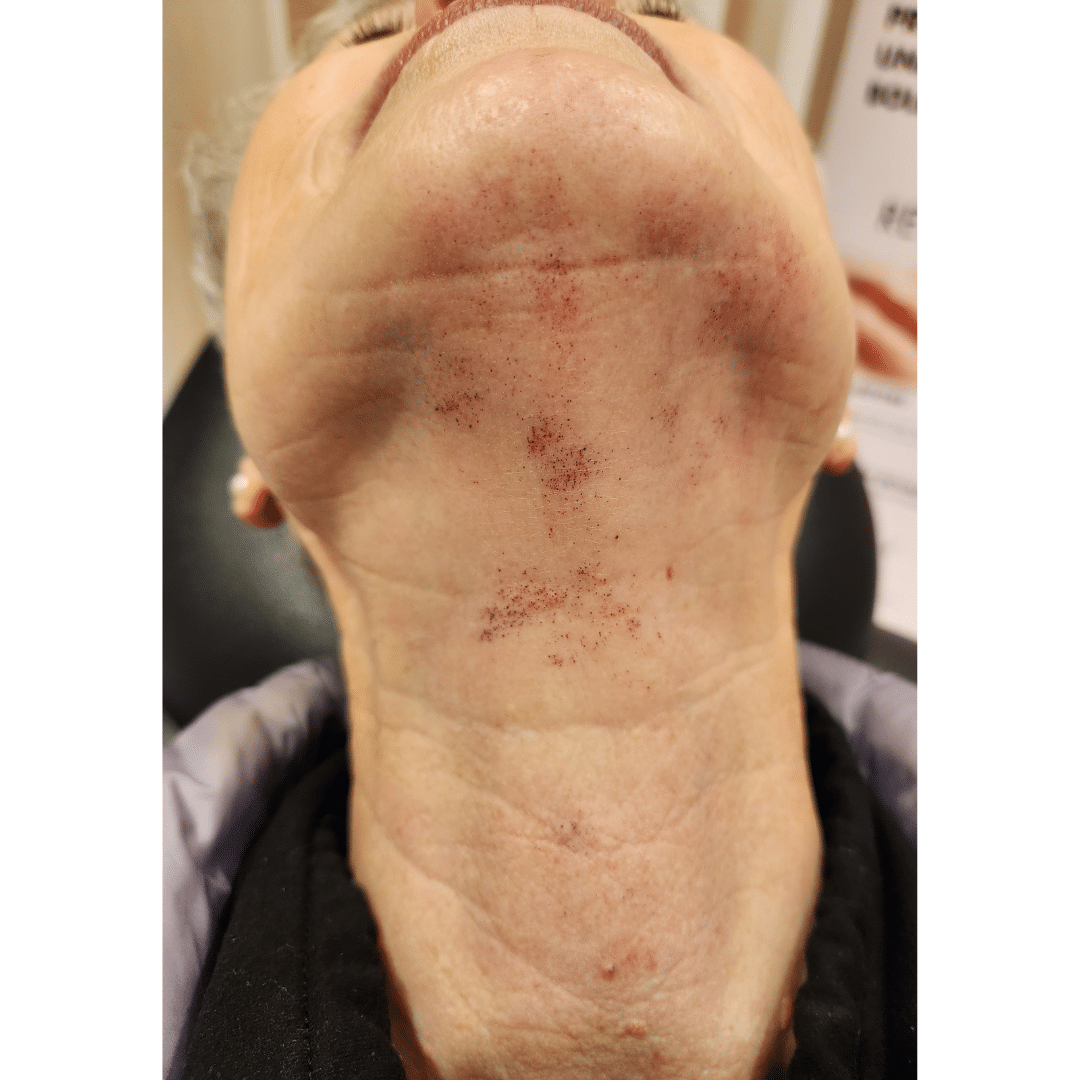 Vascular birthmark removal before Tracie Conner