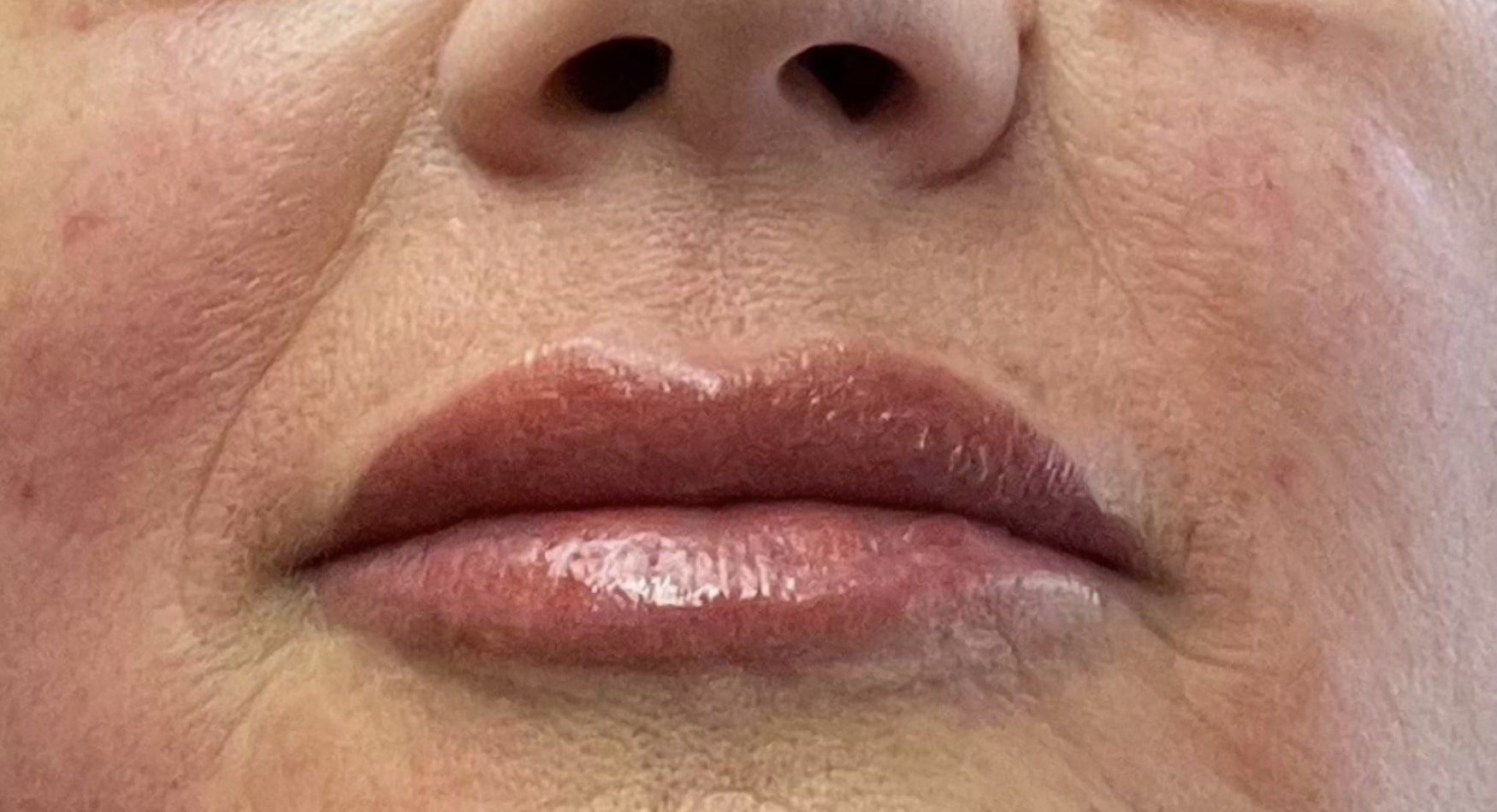 lip filler after e1744230803434