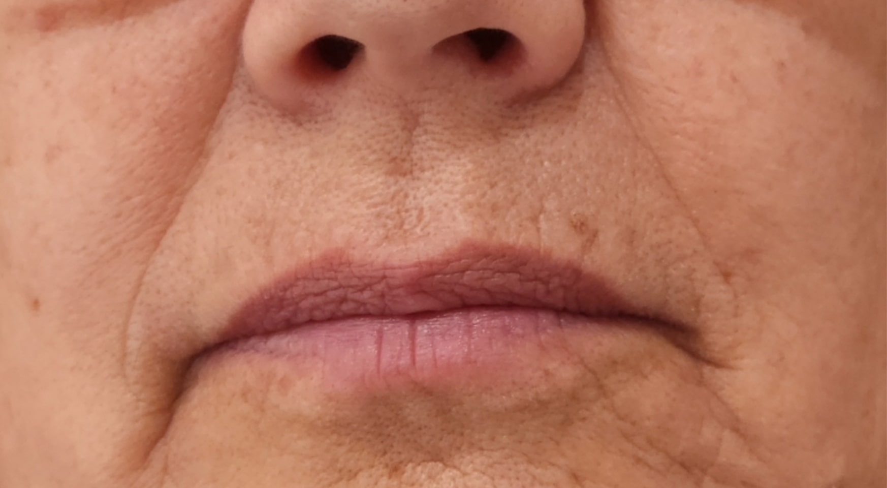 lip filler before Chelsey Herrera e1744230620874