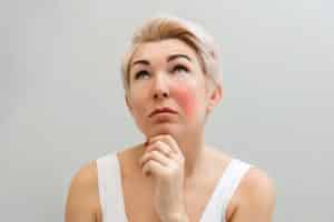 A woman with rosacea on her cheeks